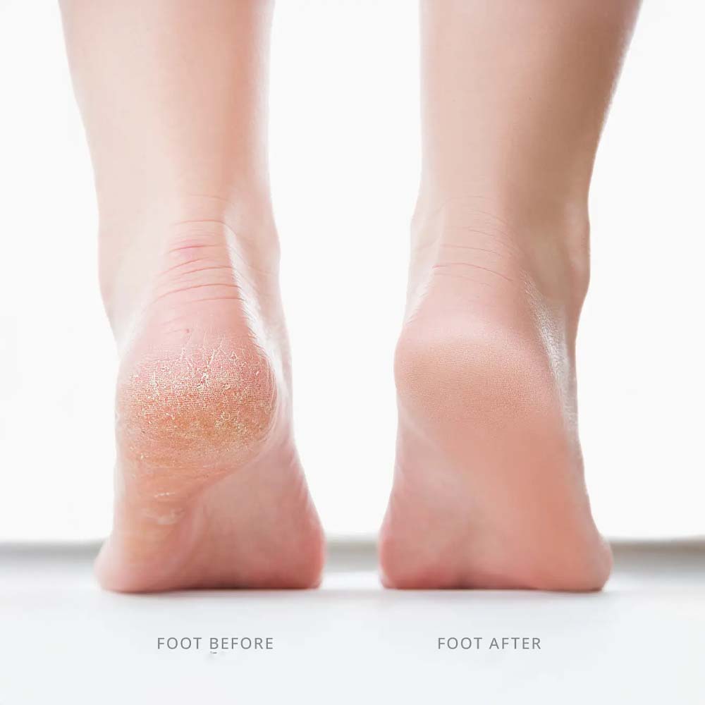 Glyssa SmoothFeet 360 Pro